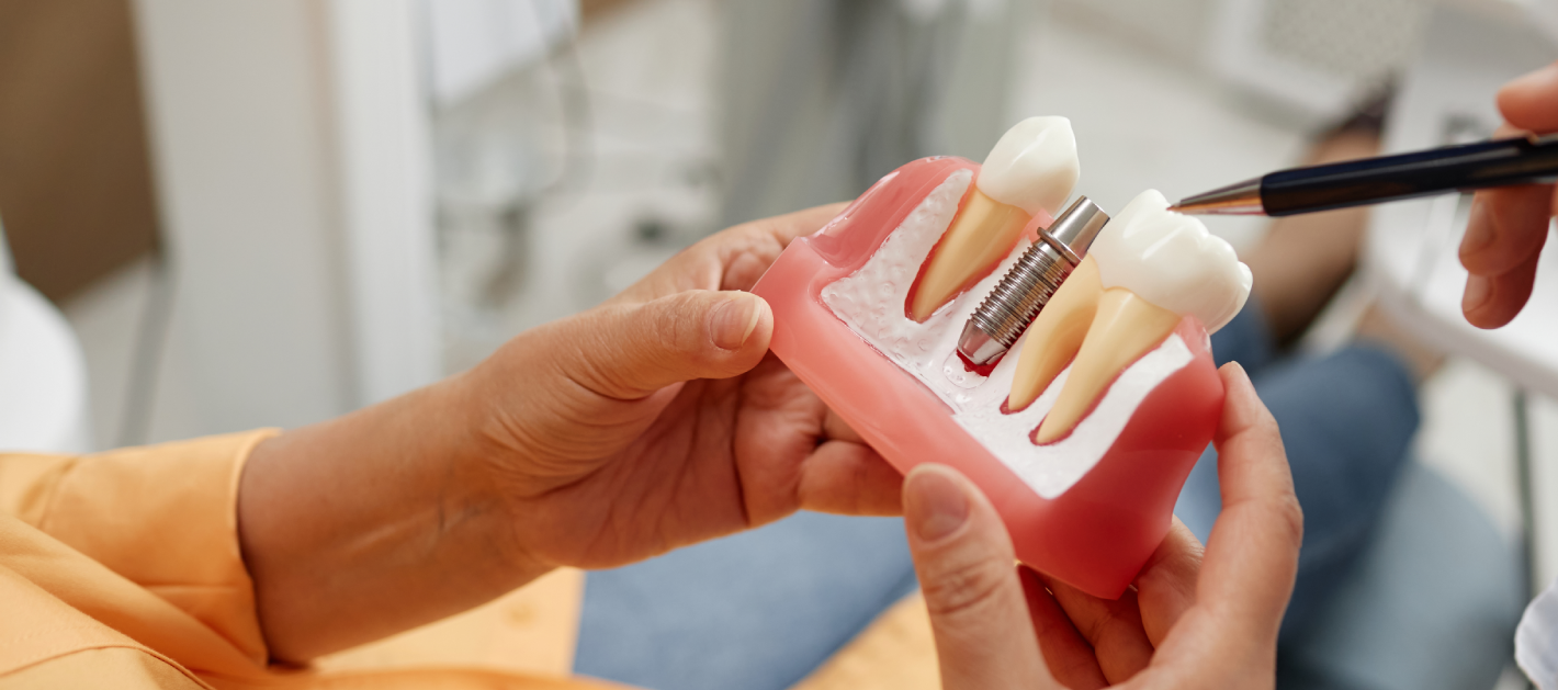 Implantes Dentales en Colombia: Calidad y Ahorro en un Solo Tratamiento