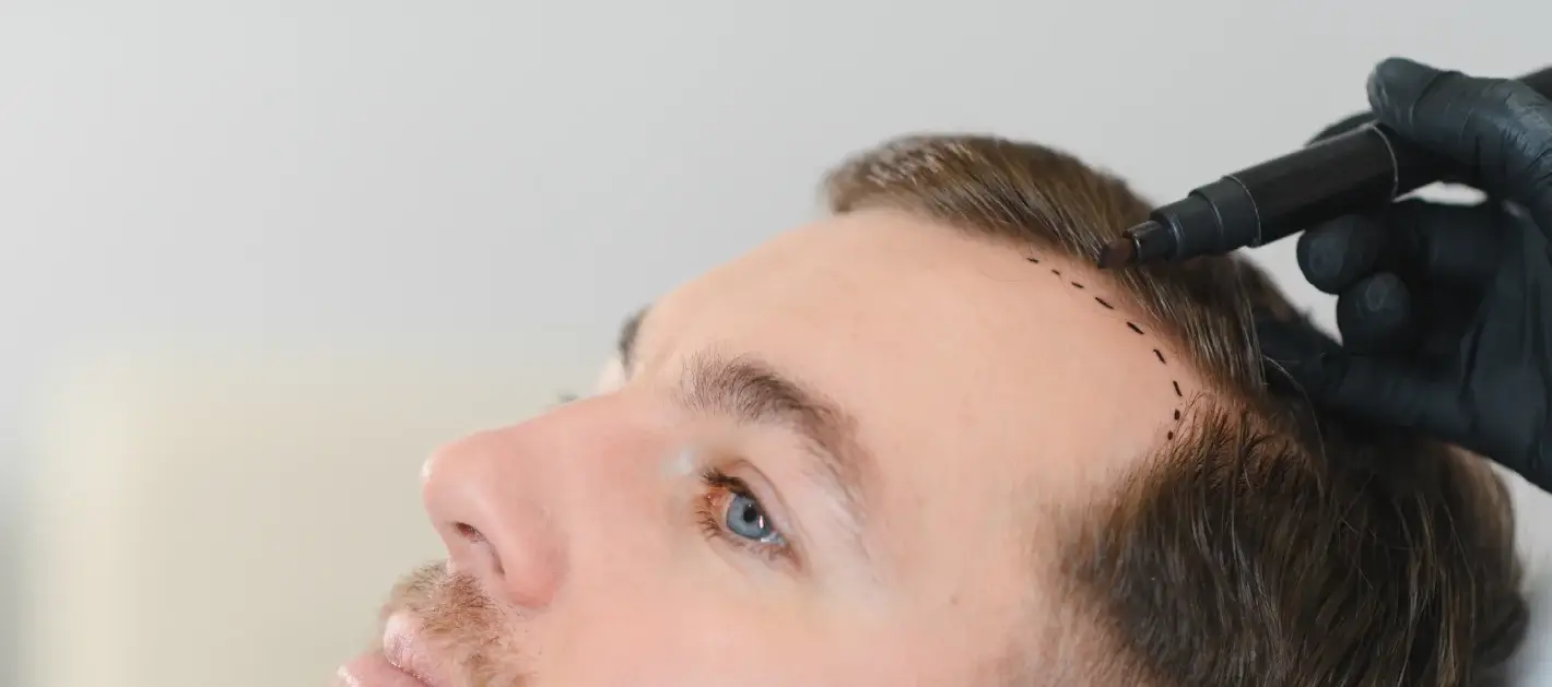 Hair Transplant in Colombia: Natural Results, Top Surgeons, and Affordable Prices
