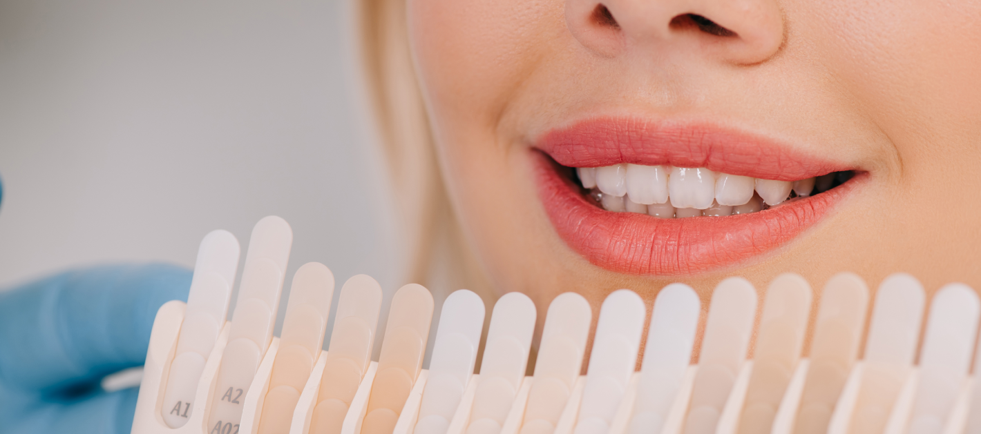 Teeth Whitening in Colombia: Improve Your Smile on Vacation